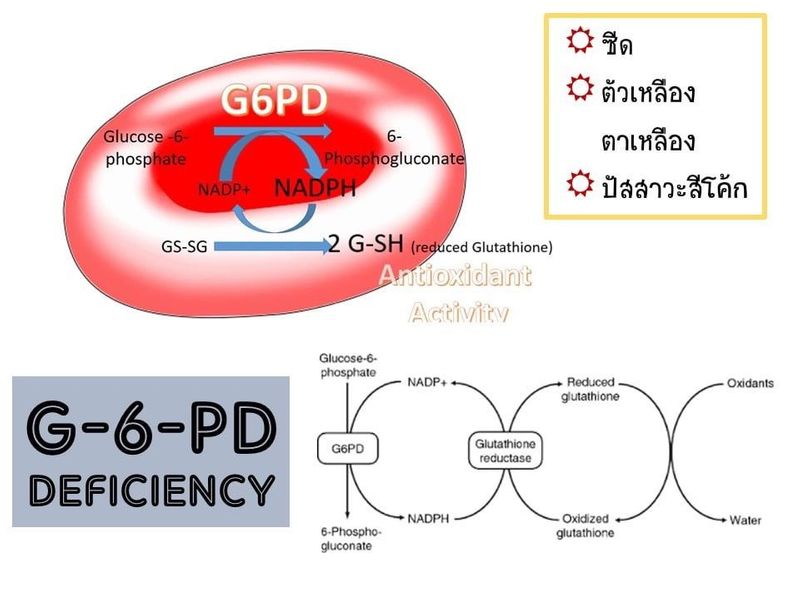 [สุขภาพดีไม่มีในขวด] G6PD Deficiency G6PD หรือภาวะซีดจากเม็ดเลือดแดงแตก