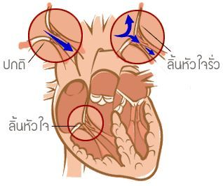 ลิ้นหัวใจยาว