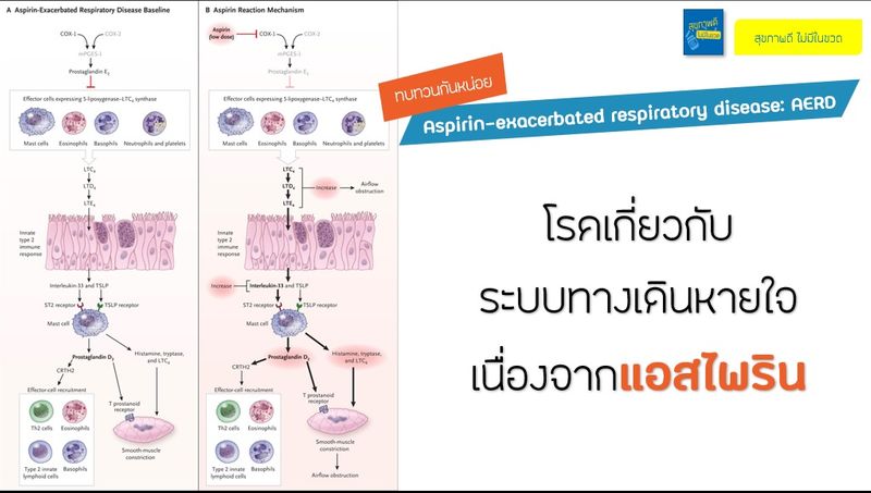 [สุขภาพดีไม่มีในขวด] โรคเกี่ยวกับระบบทางเดินหายใจเนื่องจาก #แอสไพริน ...