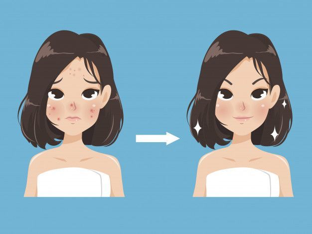 Acne And Beauty In A Young Women.