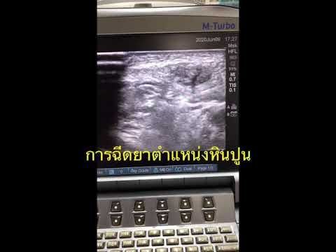 การฉีดยาตำแหน่งหินปูนของเส้นเอ็นสะบ้าหัวเข่า