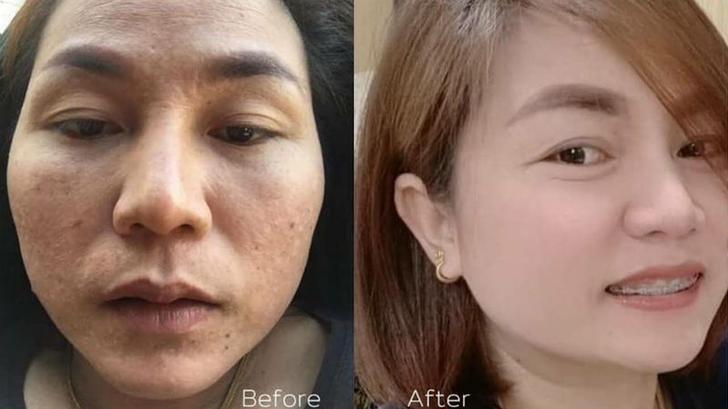 รีวิวจากเกาหลี ใช้ครีมรักษาฝ้าลาชูเล่จนหาย