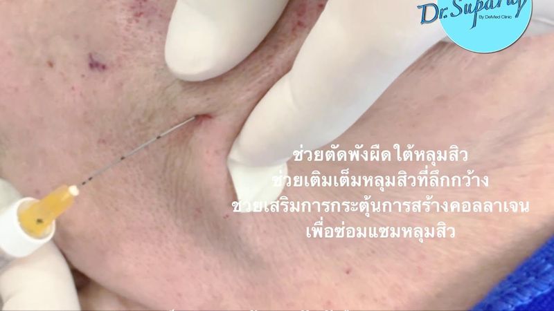 ดูแลแผลเป็นหลุมสิวด้วตัดพังผืด Blunt Subcision ร่วมกับการฉีดสารเติมเต็ม Filler DeMed Dr.Ruj