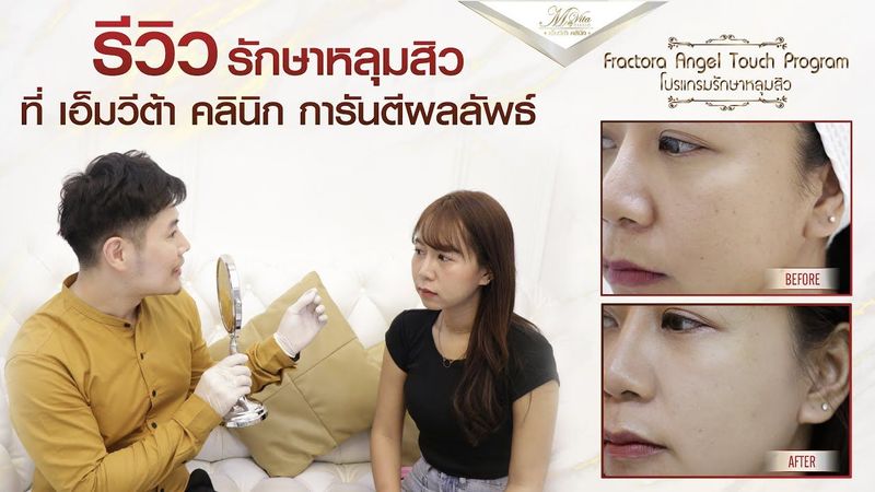 รีวิว รักษาหลุมสิว ที่ไหนดี - ที่ เอ็มวีต้า คลินิก การันตีผลลัพธ์