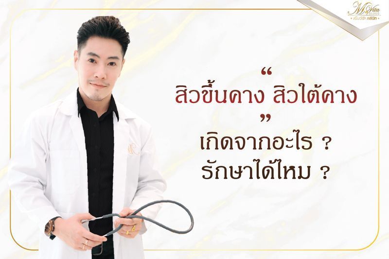 [คลินิกรักษาสิว] สิวใต้คาง สิวขึ้นคาง