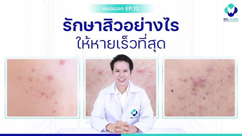 รักษาสิวอย่างไร ให้หายเร็วที่สุด | หมอบอก EP.12 | BSL CLINIC