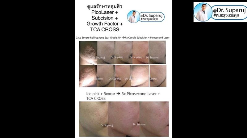 📍ตัวอย่างผลการดูแลรักษาแผลเป็นหลุมสิว ด้วยเทคนิค Multimodality Acne Scar Treatment หมอรุจชวนคุย