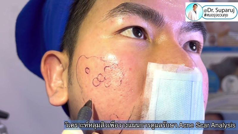 วิเคราะห์ชนิดหลุมสิวเพื่อวางแผนการรักษา Acne Scar Analysis หมอรุจชวนคุย รักษาหลุมสิว PicosecondLaser