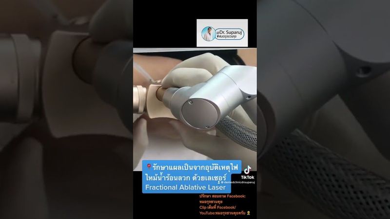 📍รักษาแผลเป็นอุบัติเหตุไฟไหม้น้ำร้อนลวก Burn Scar ด้วย Fractional Ablative Laser หมอรุจชวนคุย
