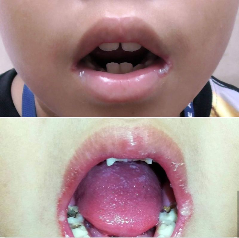 Bettercm] ????ปากนกกระจอก (Angular Cheilitis) คือ ภาวะการอักเสบที่มุมปากเกิด เป็นรอยบวมแดงในมุมปากและเป็นแผลหรือเป็นแผลที่มุมปาก ปากแห้งและแตกบริเวณที่ ริมฝีปาก โรคปากนกกระจอกสามารถเกิดได้ที่มุมปากทั้งสองข้างได้ใน