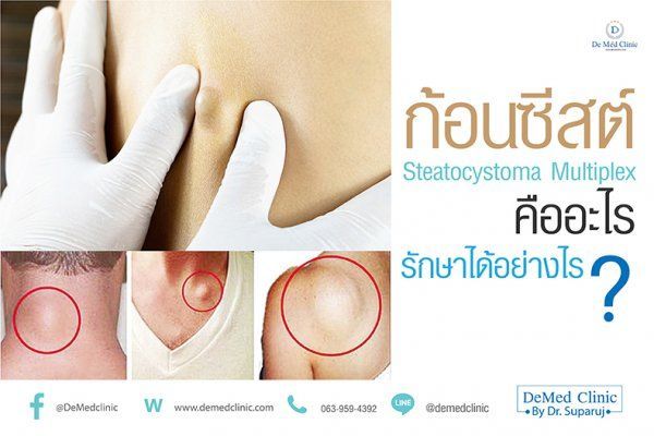 ก้อนซีสต์ Steatocystoma Multiplex คืออะไร รักษาได้อย่างไร ? - demedclinic