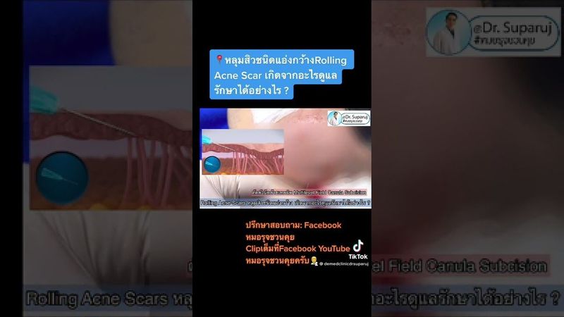หลุมสิวชนิดแอ่งกว้างRolling Acne Scar เกิดจากอะไรดูแลรักษาได้อย่างไร ? หมอรุจชวนคุย รักษาหลุมสิว