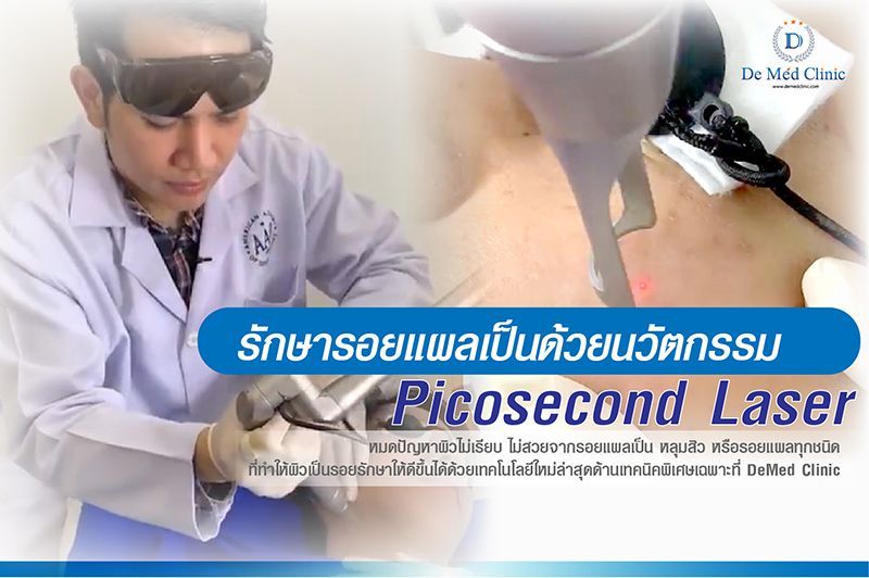 รักษารอยแผลเป็นด้วยนวัตกรรม Picosecond Laser หมดปัญหาผิวไม่เรียบ ไม่สวยจากรอยแผลเป็น หลุมสิว หรือรอยแผลทุกชนิด - demedclinic
