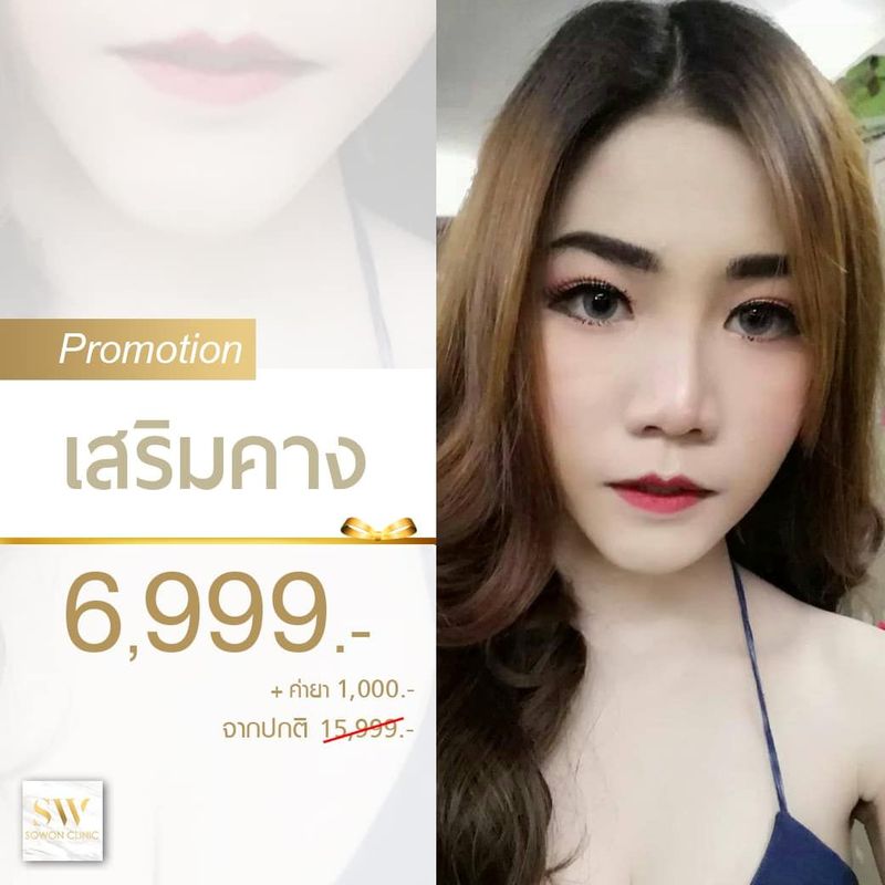 โปรโมชั่นเสริมคาง - SoWon Clinic