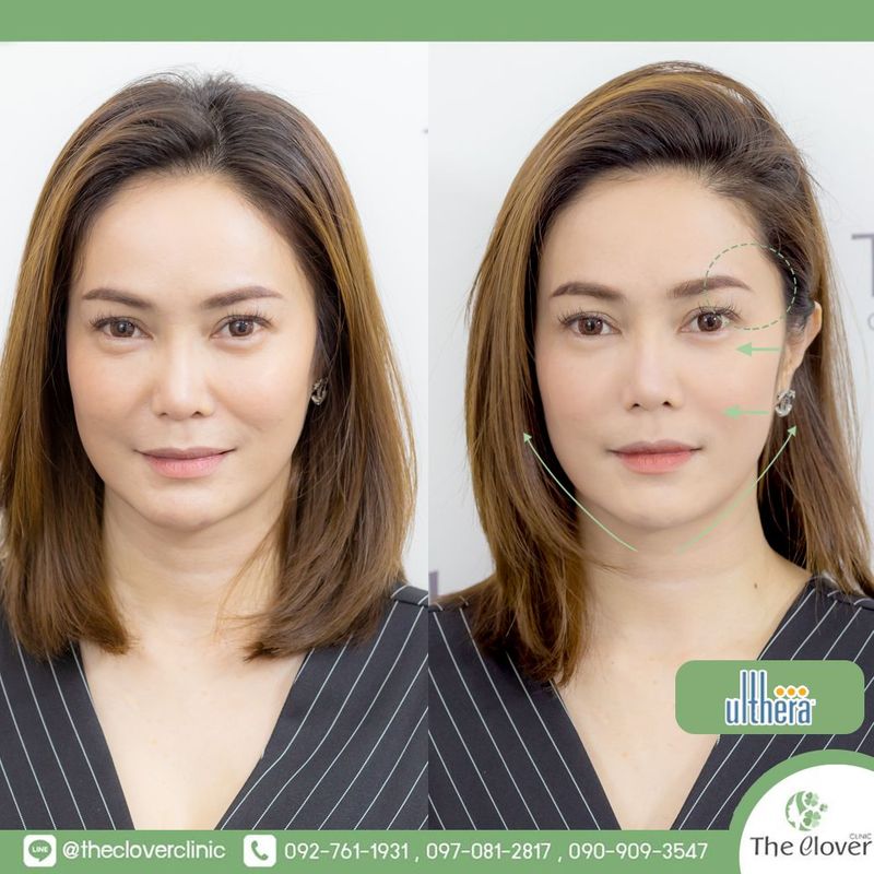 Ulthera คืออะไร ต่างจาก Thermage HIFU อย่างไร ดูแลก่อนหลังทำ