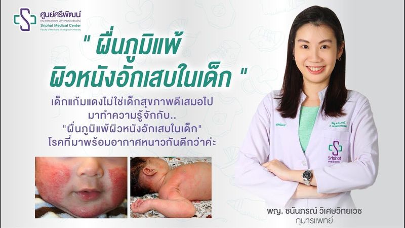 ผื่นภูมิแพ้ผิวหนังอักเสบในเด็ก