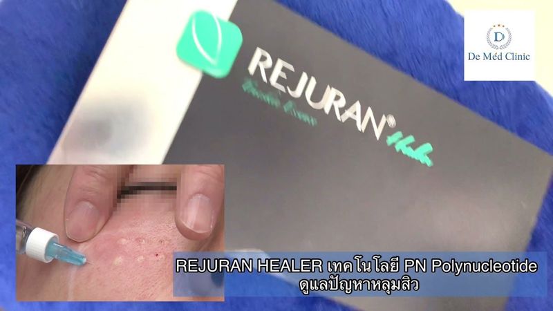 📍REJURAN HEALER เทคโนโลยี PN Polynucleotide ดูแลปัญหาหลุมสิว Acne Scar Treatment