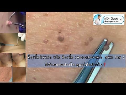ติ่งเนื้อผิวหนัง ติ่งเนื้อ มีลักษณะอย่างไร ดูแลได้อย่างไร Skin Tag Removal หมอรุจชวนคุย CO2 Laser