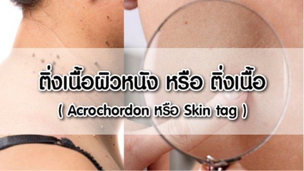 ติ่งเนื้อผิวหนัง หรือ ติ่งเนื้อ (Acrochordon หรือ Skin tag ) - demedclinic