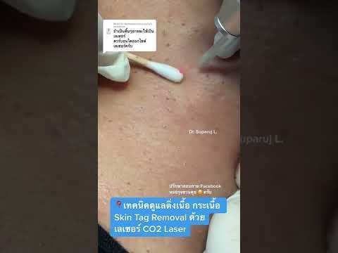รักษาติ่งเนื้อ กระเนื้อ Skin Tag Removal ด้วยคาร์บอนไดออกไซด์เลเซอร์ CO2 Laser หมอรุจชวนคุย