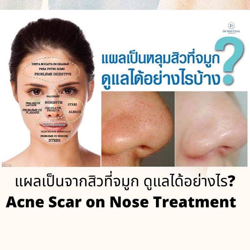 [DeMed Clinic ดูแลผิวสิวแผลเป็นหลุมสิวเส้นผม] 📍แผลเป็นจากสิวที่จมูก ดูแลได้อย่างไร Acne Scar on