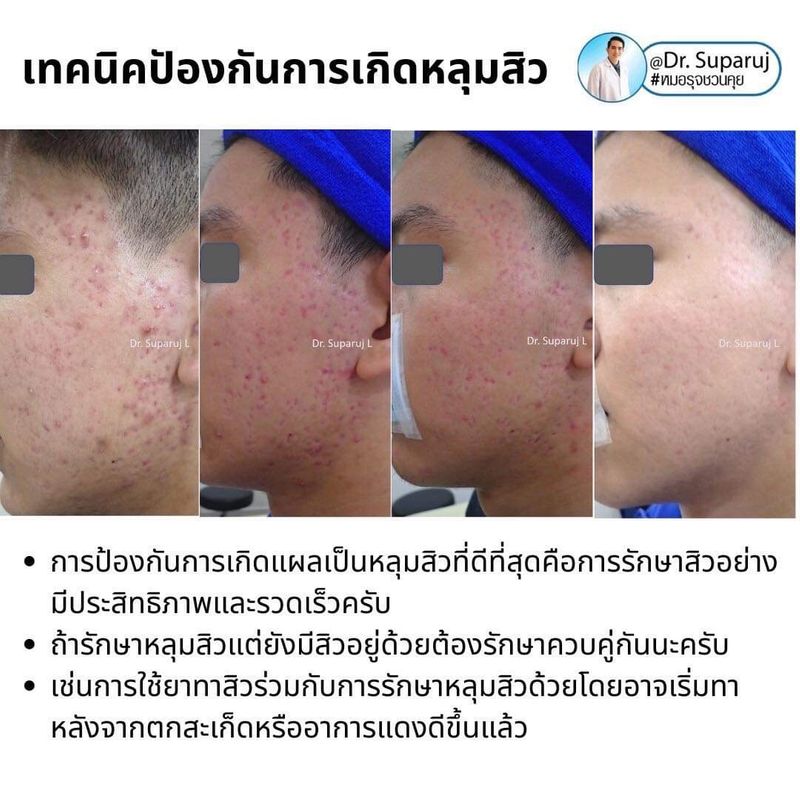 [DeMed Skin Product เวชสำอางคุณภาพ สิว ฝ้า ผมร่วง] 📍รักษาหลุมสิวแล้ว