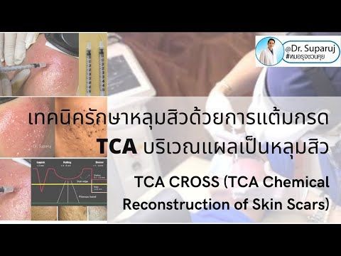 เทคนิครักษาหลุมสิวด้วยการแต้มกรด TCATCA CROSS (TCA Chemical Reconstruction of Skin Scar)