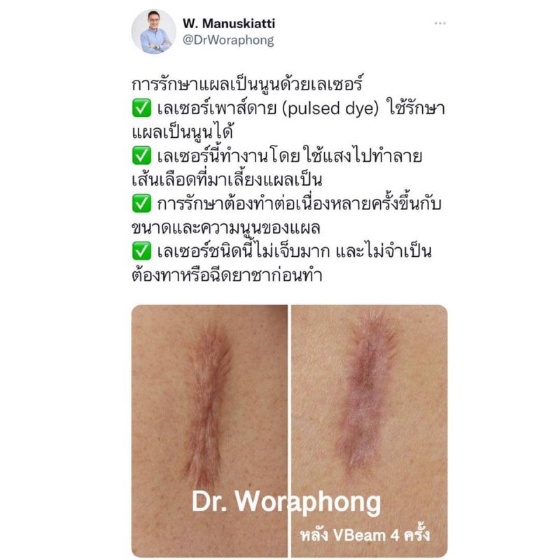 [DeMed Skin Product เวชสำอางคุณภาพ สิว ฝ้า ผมร่วง] 📍การรักษาแผลเป็นนูน