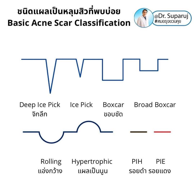 [DeMed Clinic ดูแลผิวสิวแผลเป็นหลุมสิวเส้นผม] 📍 ทำความรู้จักชนิดของหลุม ...