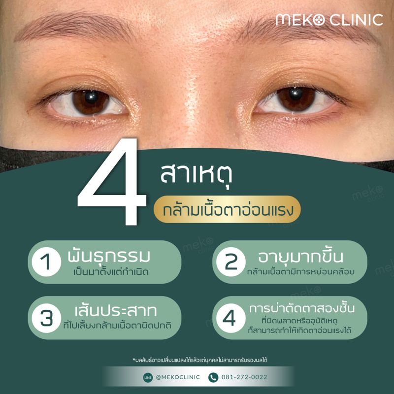 [beautyCube] แนะนำกล้ามเนื้อตาอ่อนแรงคือ ? เกิดจากอะไร แก้ไขหรือรักษา ...