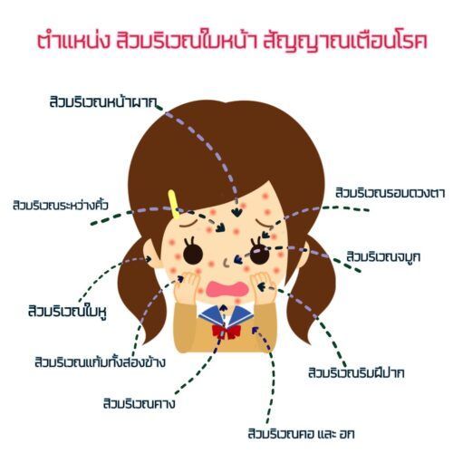 ตำแหน่ง สิวบริเวณใบหน้า สัญญาณเตือนโรค ที่ควรระวัง