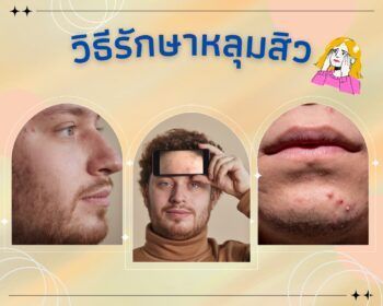 วิธีรักษาหลุมสิว ให้หน้ากลับมาใส เรียบเนียนกริบ