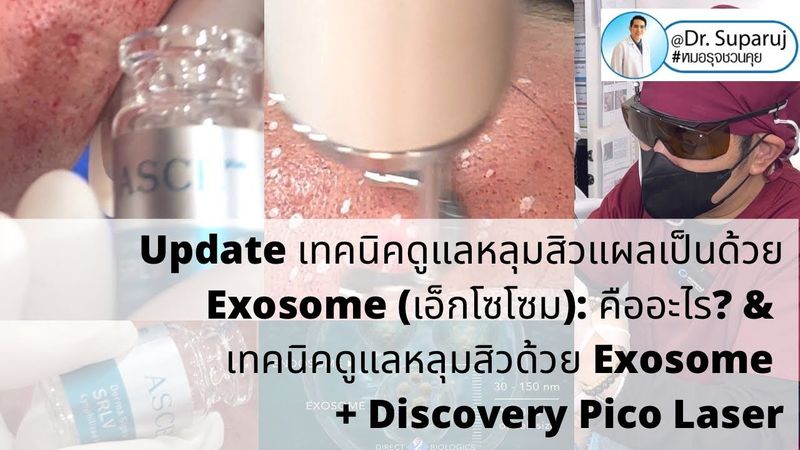 Update เทคนิคดูแลหลุมสิว: เทคนิคดูแลหลุมสิวด้วย Exosome Therapy + Discovery Picosecond Laser