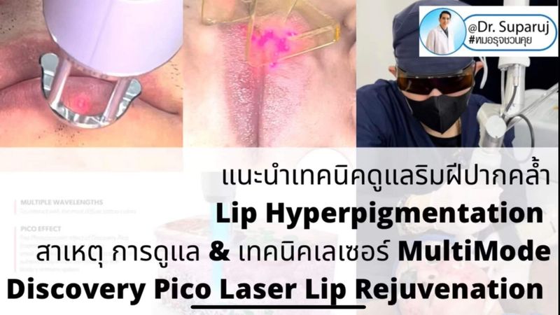 Demed Clinic ดูแลผิวสิวแผลเป็นหลุมสิวเส้นผม] ????แนะนำเทคนิคดูแลริมฝีปากคล้ำ  Lip Hyperpigmentation ????แนะนำเทคนิคดูแลริมฝีปากคล้ำ Lip Hyperpigmentation  ริ้วรอย ริ้วรอยรอบริมฝีปาก: สาเหตุ การดูแล & เทคนิคเลเซอร์ Multimode  Discovery Picosecond Laser