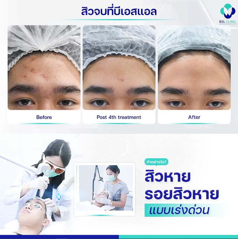 Bsl Clinic] ????‍???? ทำยังไงให้รอยสิวหาย สิวหาย เร็วที่สุด ????  ปรึกษาผู้เชี่ยวชาญเรื่องสิว รอยสิว โดยเฉพาะ