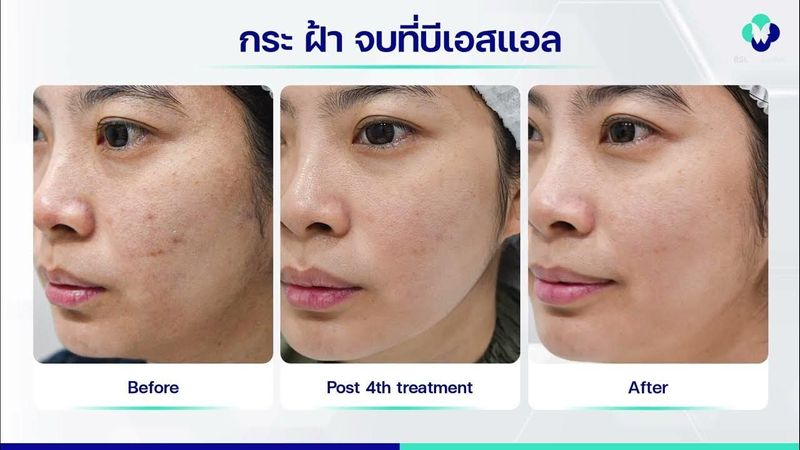 หน้าเป็นฝ้า กระ BSL จัดการให้จางลง หน้าใส ไม่ต้องพึ่งเมคอัพ