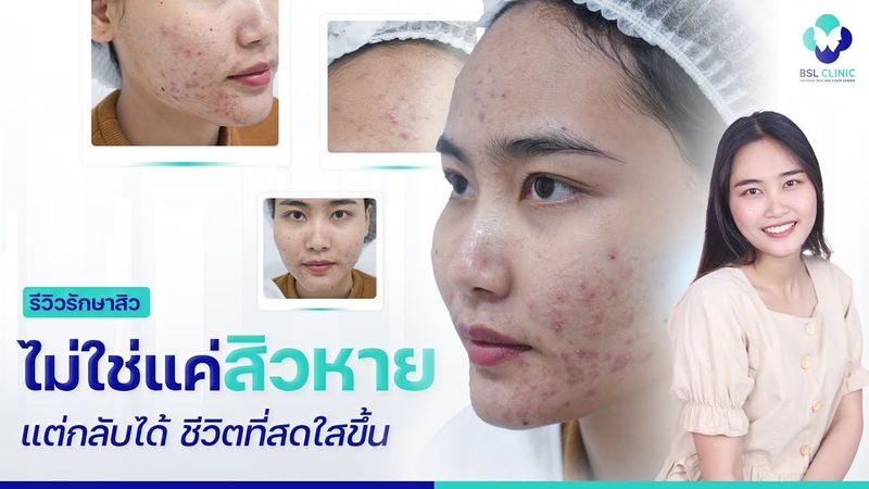 ไม่ใช่แค่สิวหาย แต่กลับได้ ชีวิตที่สดใสขึ้น | รีวิวรักษาสิว | BSL CLINIC