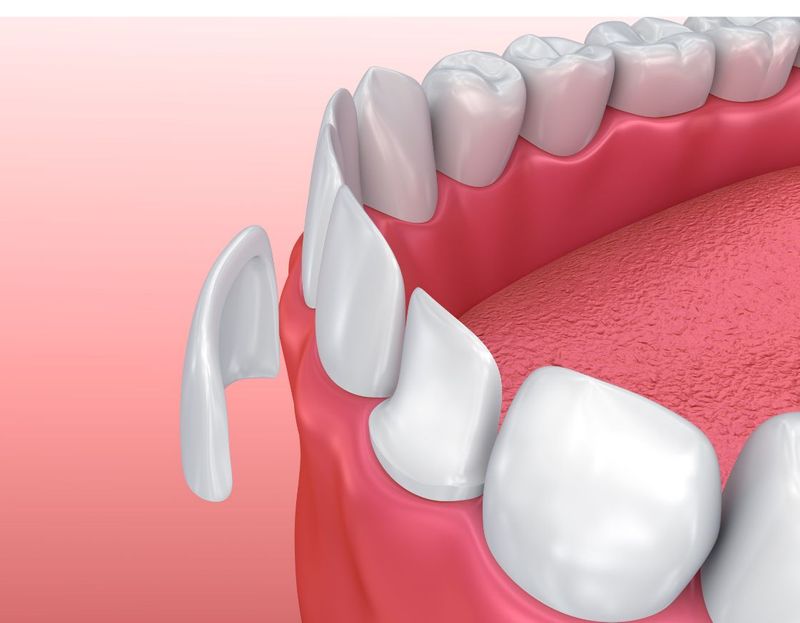 Best Dental Veneers in Bangkok | Make Appointment