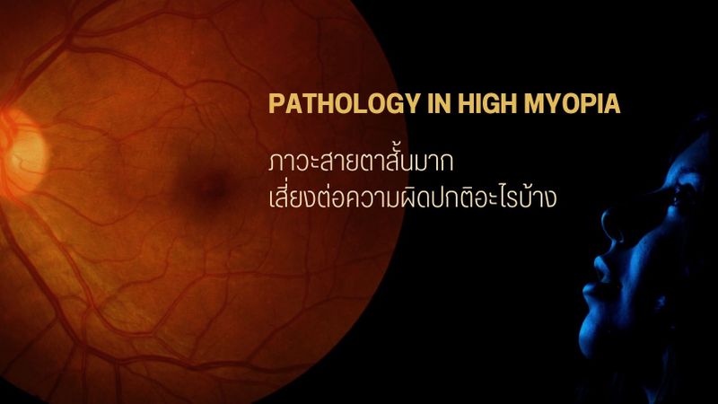[ทัศนมาตร รีพอร์ต] • PATHOLOGY IN HIGH MYOPIA ภาวะสายตาสั้นมาก เสี่ยง ...