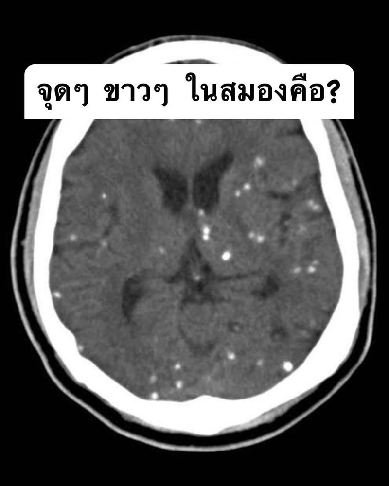 [Waiyaow.fantasy7896] คนไข้ ปวดหัวมา มีวูบๆ X ray คือ พยาธิ แข็งตัวเป็น ...