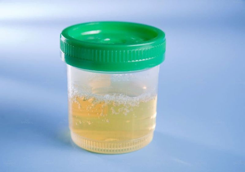 Nước tiểu có bọt có nguy hiểm không? Nguyên nhân, Chẩn đoán, Phòng tránh