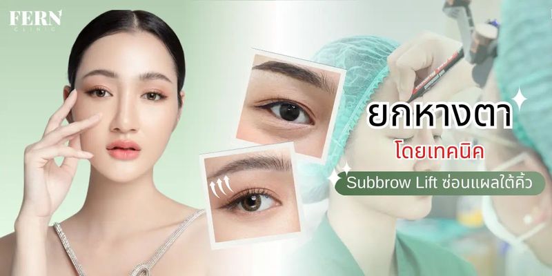 ยกหางตา โดยเทคนิค Subbrow Lift ซ่อนแผลใต้คิ้ว - Fern clinic