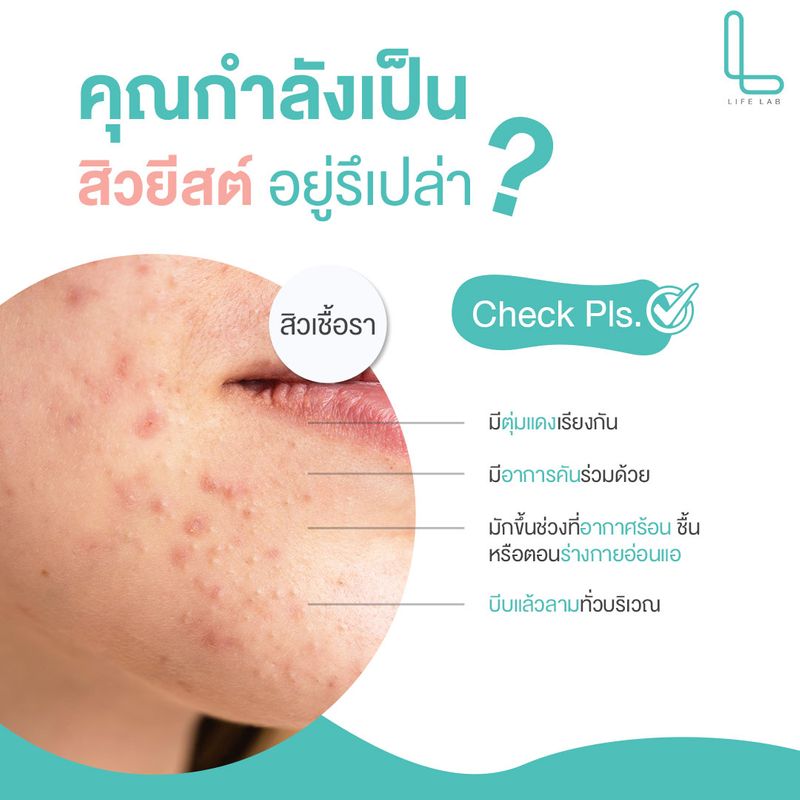 [LifeLab] 🧐สิวยีสต์ เจ้าตัวร้ายที่หน้าตาคล้ายสิวผด มองด้วยตาเปล่าแทบแยก