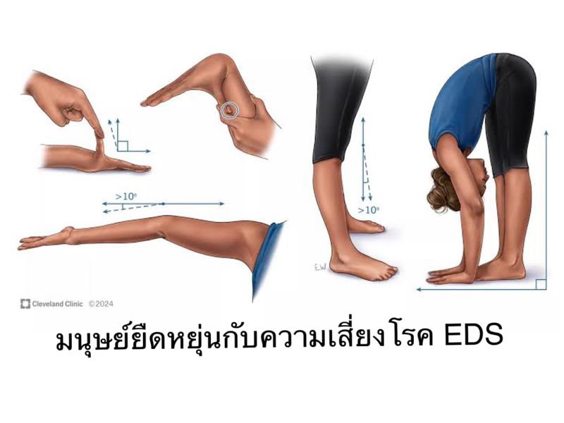 [หมอเฝิง แพทย์แผนจีน] โรค EDS กลุ่ม Hypermobility โรค EDS (Ehler-Danlos ...