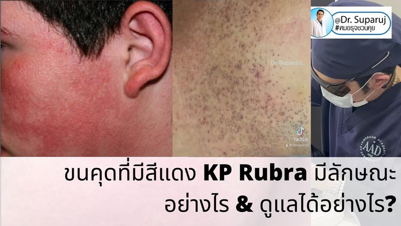 [หมอรุจชวนคุย Dr. Suparuj ผมผิวสิวหลุมสิวแผลเป็น] 📍 ขนคุดที่มีสีแดง KP ...