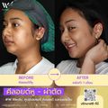 W⁺ Medic Clinic ศูนย์เลเซอร์ คีลอยด์ และแผลเป็น