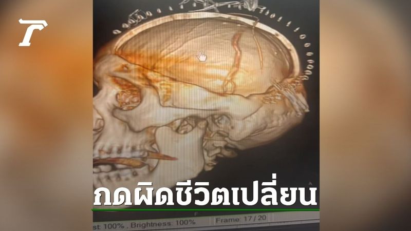 แพทย์แชร์อุทาหรณ์ ผัวให้เมียนวดต้นคอ กดผิด เส้นเลือดที่คอปริแตก-สมองตาย