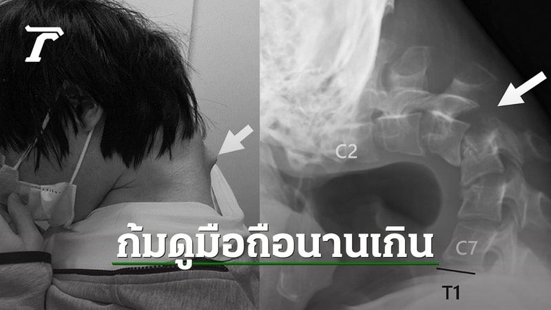หนุ่มญี่ปุ่นปวดคอเงยหน้าไม่ได้ แพทย์วินิจฉัยเป็นโรค ”กลุ่มอาการคอตก” ก้มหน้าดูจอมือถือเป็นเวลานาน