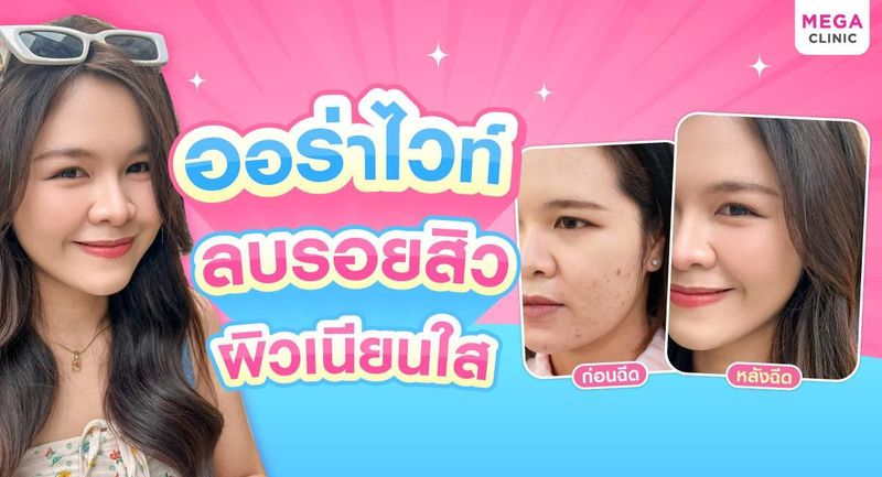 ฉีดออร่าไวท์ ช่วยลดรอยสิว รอยดําจากสิว ได้จริงไหม? | MEGA CLINIC