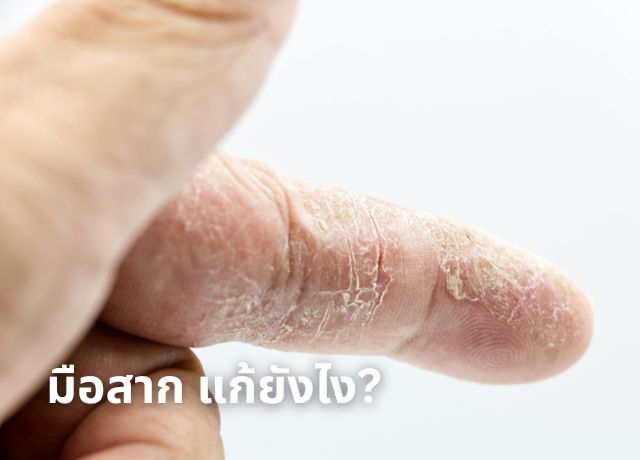 หมดปัญหามือสาก! เปิด วิธีแก้ผิวมือแห้ง พร้อมเคล็ดลับ บำรุงมือ ให้กลับมาเนียนนุ่ม